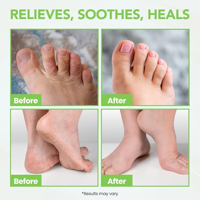 Thena Athletes Foot Cream Extra Strength Herbal Relief with Tea Tree Neem & Menthol, Athletes Foot Treatment Balm for Itchy Dry Cracked Feet, Heels and Toes, Advanced Plant-Based Foot Care