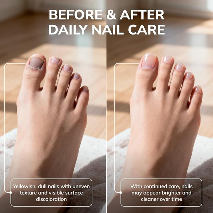 Swissklip KlearNail Toenail Stick | Medi-Care Treatment | Natural Solution for Healthy Nails I Suitable For Foot, Toe, and Fingernail I For Brittle Toenails – 10ml / 0.3 Fl. Oz. Pack 1 - Made in USA